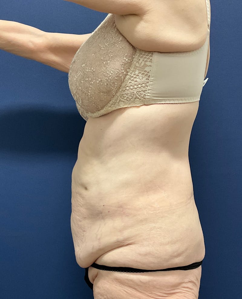 Tummy Tuck by Dr. Booth Before & After Gallery - Patient 323399 - Image 7