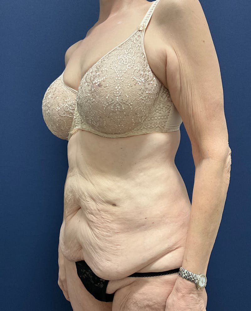 Tummy Tuck by Dr. Booth Before & After Gallery - Patient 323399 - Image 5