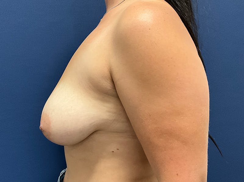  Breast Lift with Augmentation Dr. Booth Before & After Gallery - Patient 406839 - Image 9