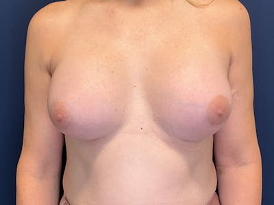 Breast Augmentation by Dr. Booth Before & After Gallery - Patient 691259 - Image 2