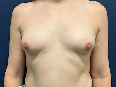 Breast Augmentation by Dr. Booth Before & After Gallery - Patient 691259 - Image 1