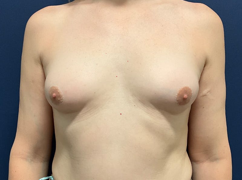 Breast Augmentation by Dr. Booth Before & After Gallery - Patient 691259 - Image 1