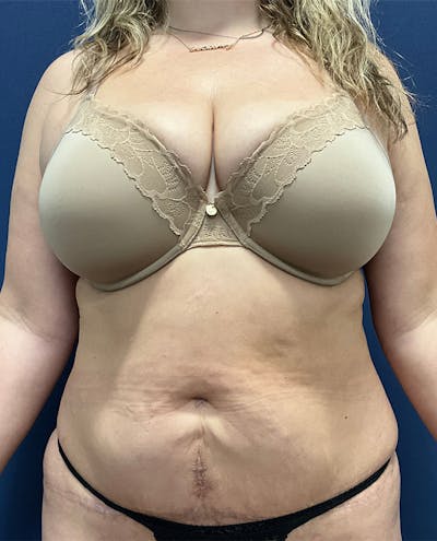 Tummy Tuck by Dr. Booth Before & After Gallery - Patient 426555 - Image 1