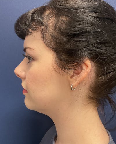 MyEllevate by Dr. Booth Before & After Gallery - Patient 745205 - Image 1