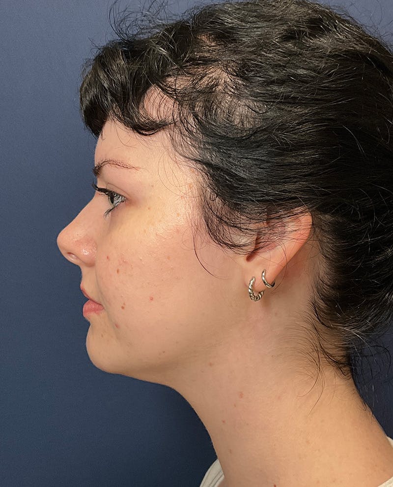 MyEllevate by Dr. Booth Before & After Gallery - Patient 745205 - Image 2