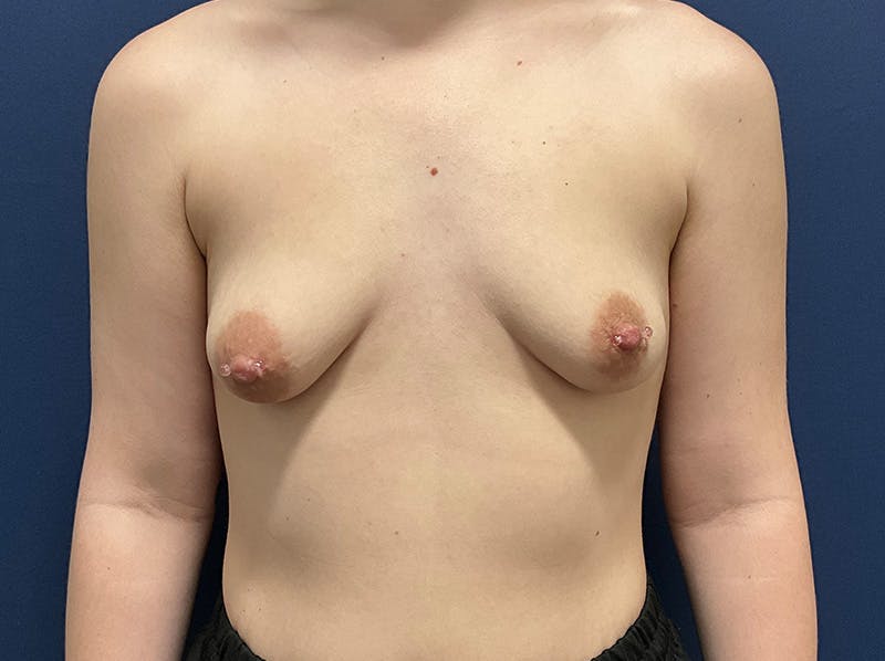 Breast Augmentation by Dr. Booth Before & After Gallery - Patient 406632 - Image 3