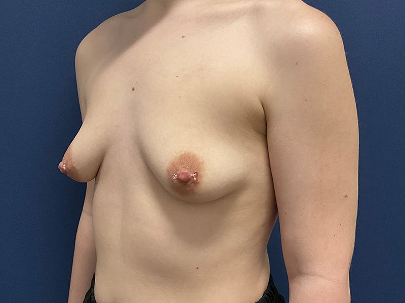 Breast Augmentation by Dr. Booth Before & After Gallery - Patient 406632 - Image 5