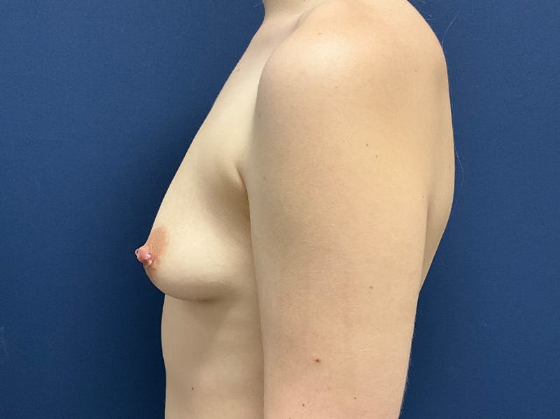 Breast Augmentation by Dr. Booth Before & After Gallery - Patient 406632 - Image 7