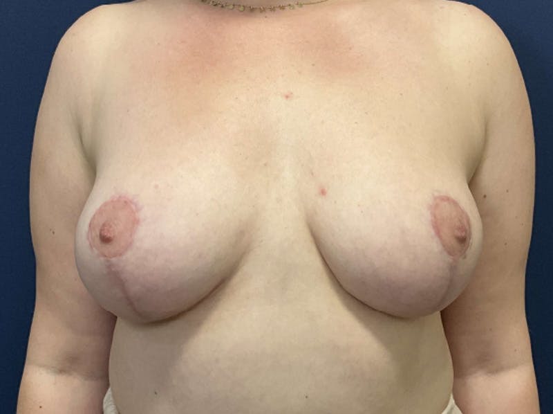 Breast Reduction by Dr. Booth Before & After Gallery - Patient 420904 - Image 2