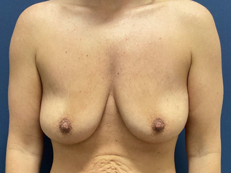  Breast Lift with Augmentation Dr. Booth Before & After Gallery - Patient 237523 - Image 1