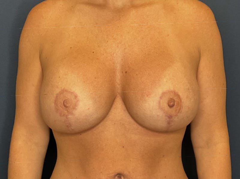  Breast Lift with Augmentation Dr. Booth Before & After Gallery - Patient 237523 - Image 2
