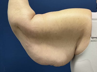 Brachioplasty by Dr. Booth Before & After Gallery - Patient 313469 - Image 1