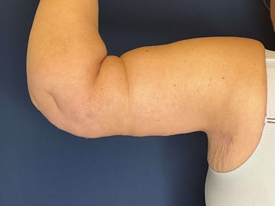 Brachioplasty by Dr. Booth Before & After Gallery - Patient 313469 - Image 2