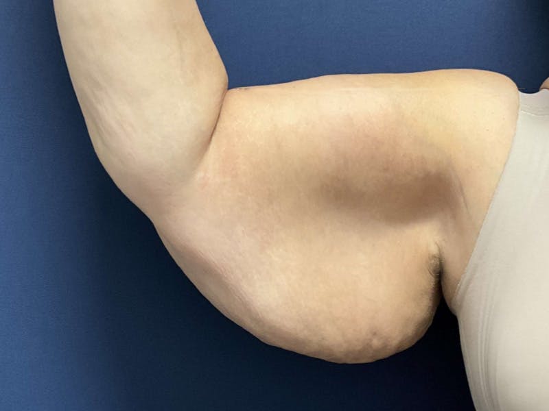 Brachioplasty by Dr. Booth Before & After Gallery - Patient 313469 - Image 3