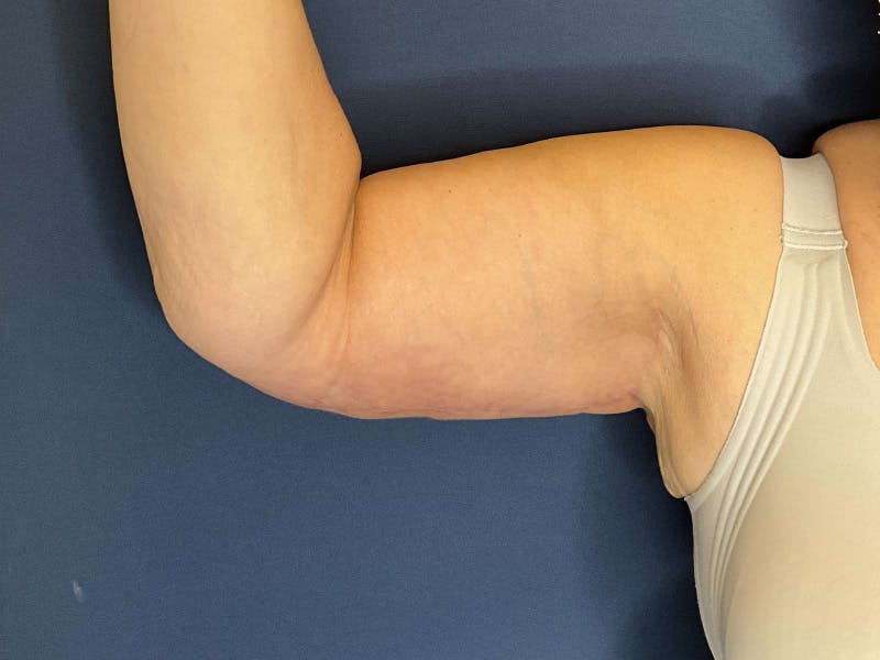 Brachioplasty by Dr. Booth Before & After Gallery - Patient 313469 - Image 4