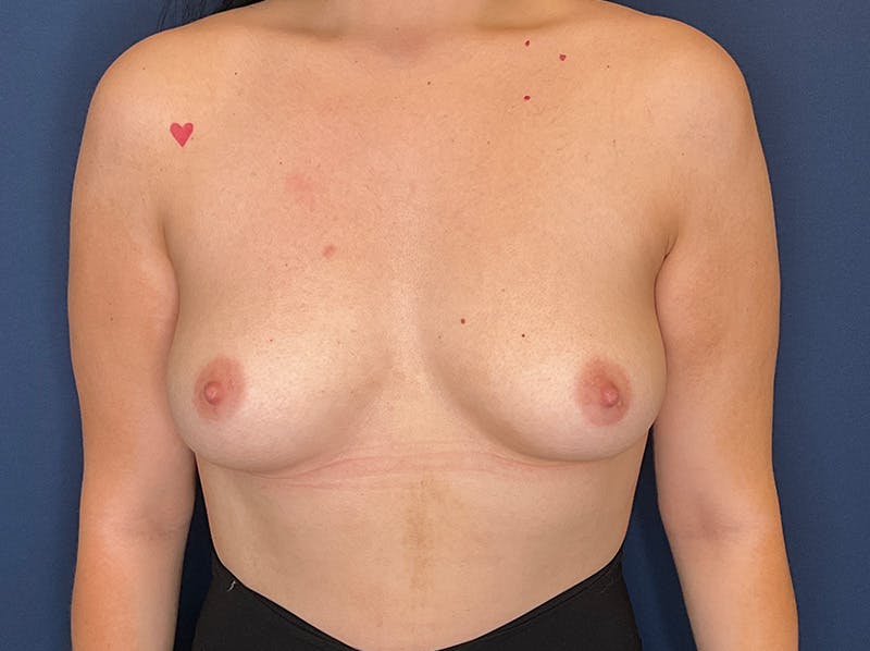 Breast Augmentation by Dr. Booth Before & After Gallery - Patient 101054 - Image 3