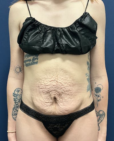 Tummy Tuck by Dr. Booth Before & After Gallery - Patient 107888 - Image 1