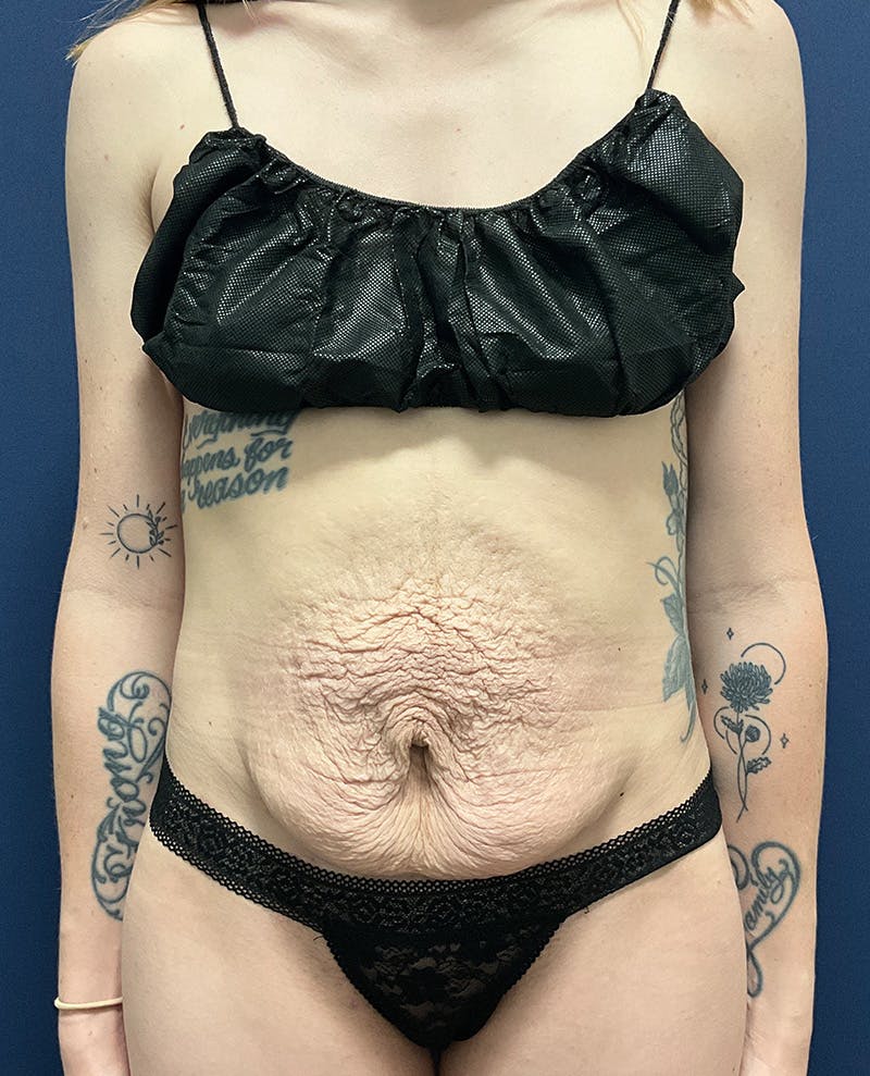 Tummy Tuck by Dr. Booth Before & After Gallery - Patient 107888 - Image 1
