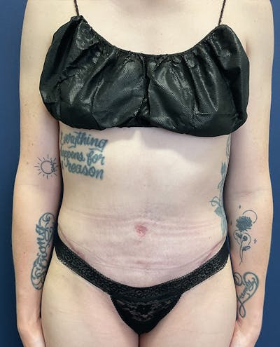 Tummy Tuck by Dr. Booth Before & After Gallery - Patient 107888 - Image 2