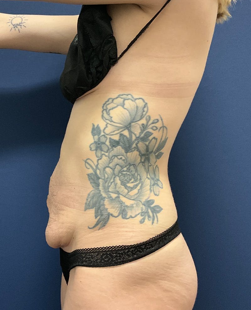 Tummy Tuck by Dr. Booth Before & After Gallery - Patient 107888 - Image 5