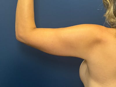 Brachioplasty by Dr. Booth Before & After Gallery - Patient 140986 - Image 2