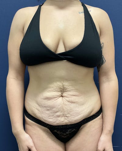 Tummy Tuck by Dr. Booth Before & After Gallery - Patient 282712 - Image 1