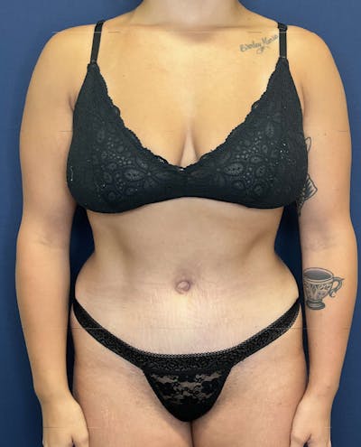 Tummy Tuck by Dr. Booth Before & After Gallery - Patient 282712 - Image 2