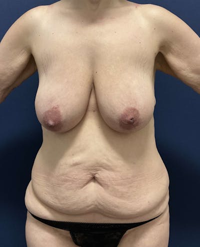 Tummy Tuck by Dr. Booth Before & After Gallery - Patient 410343 - Image 1