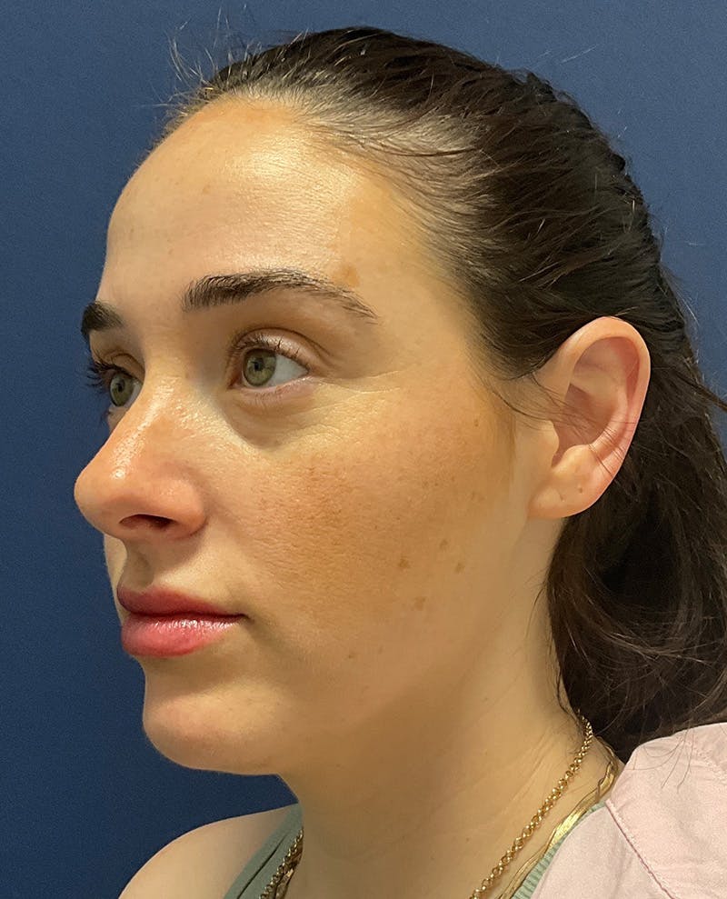 MyEllevate by Dr. Booth Before & After Gallery - Patient 198595 - Image 2