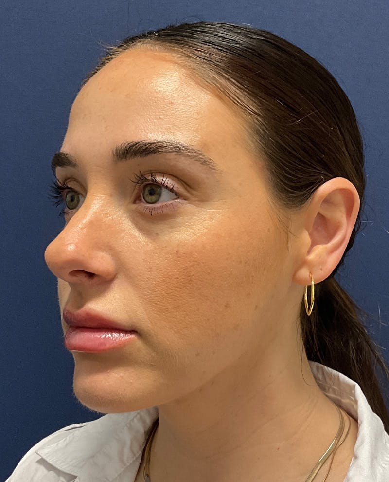 MyEllevate by Dr. Booth Before & After Gallery - Patient 198595 - Image 1