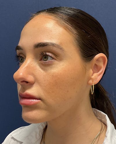 MyEllevate by Dr. Booth Before & After Gallery - Patient 198595 - Image 1