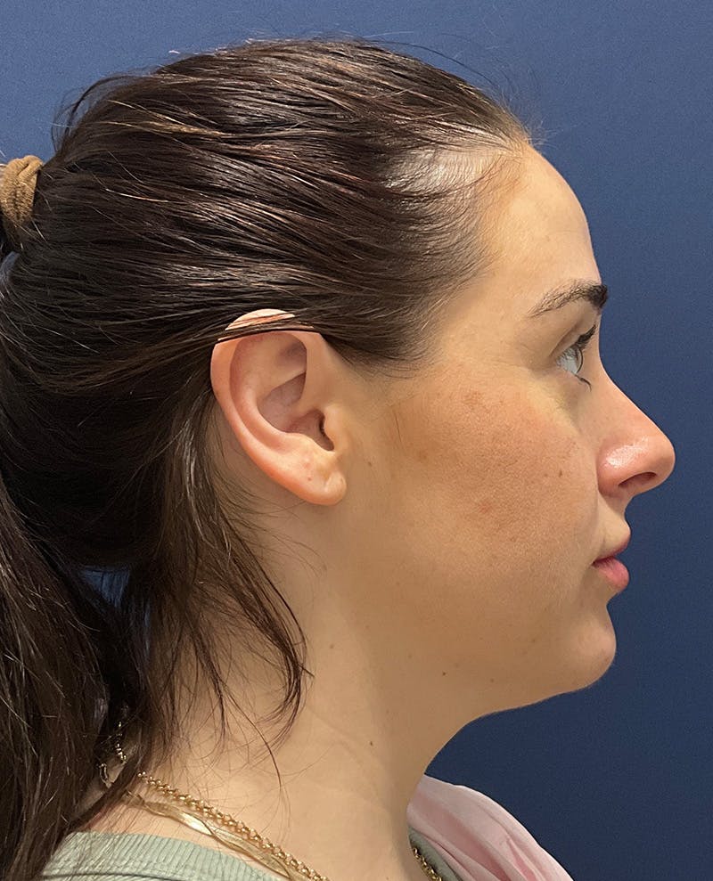 MyEllevate by Dr. Booth Before & After Gallery - Patient 198595 - Image 3
