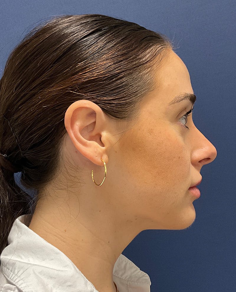 MyEllevate by Dr. Booth Before & After Gallery - Patient 198595 - Image 4