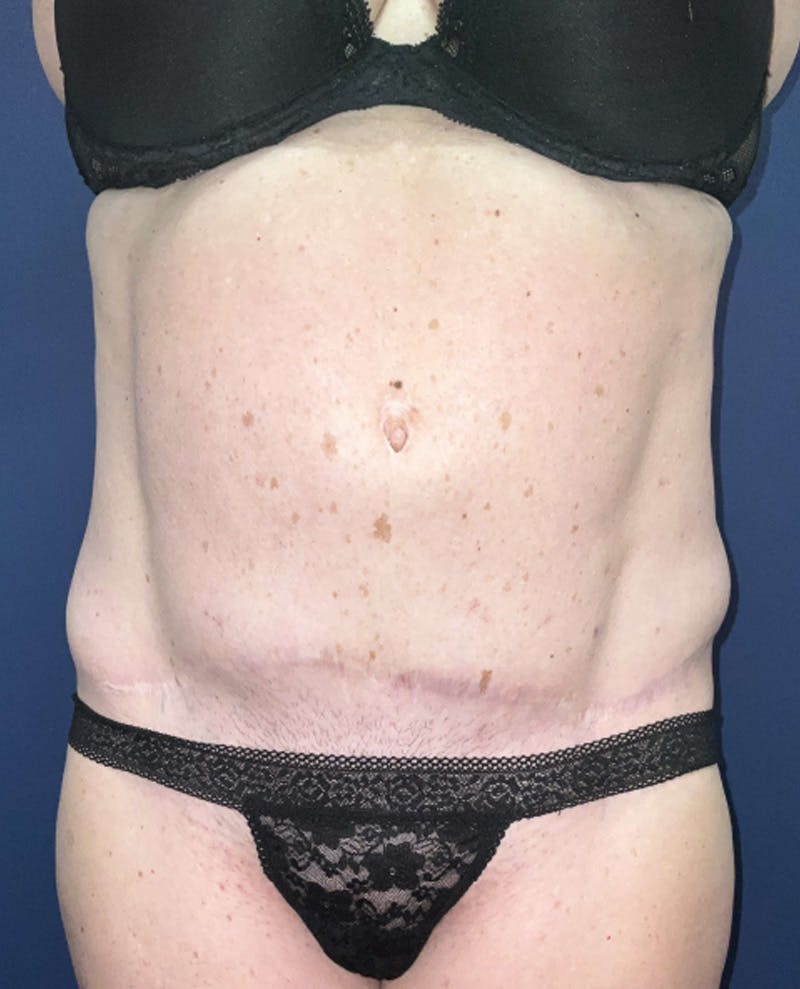 Liposuction by Dr. Booth Before & After Gallery - Patient 424767 - Image 1