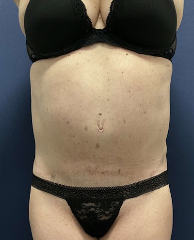 Liposuction by Dr. Booth Before & After Gallery - Patient 424767 - Image 2