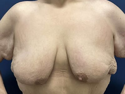  Breast Lift with Augmentation Dr. Booth Before & After Gallery - Patient 121632 - Image 1