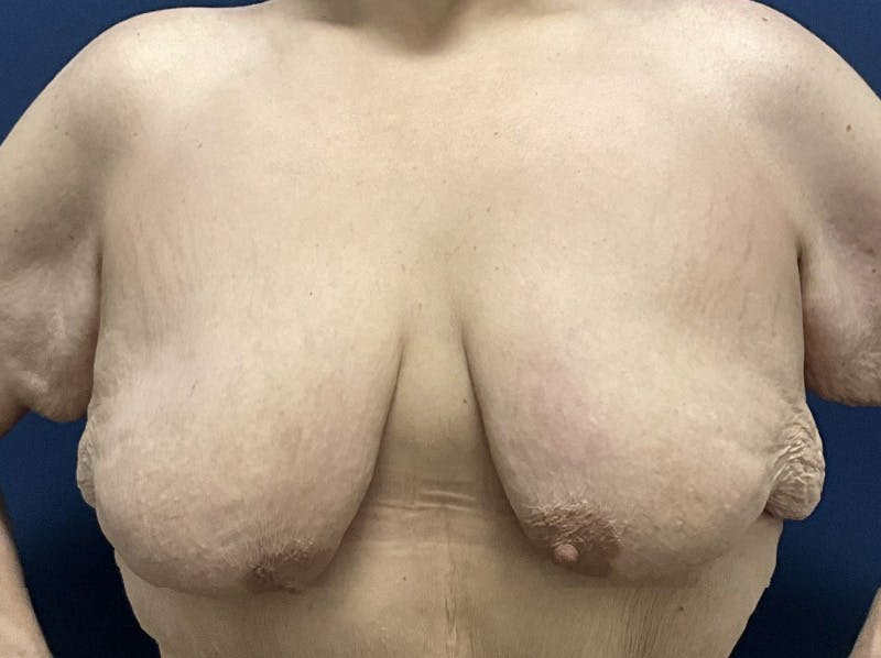  Breast Lift with Augmentation Dr. Booth Before & After Gallery - Patient 121632 - Image 1
