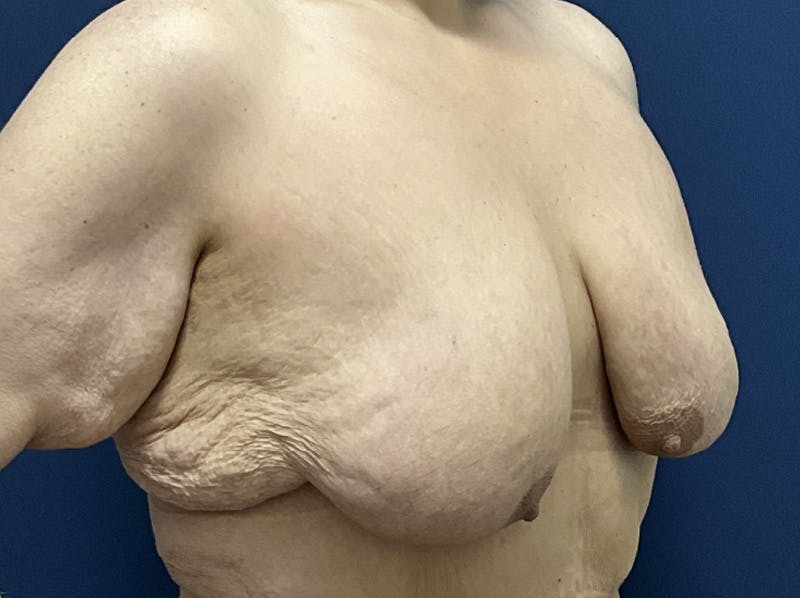  Breast Lift with Augmentation Dr. Booth Before & After Gallery - Patient 121632 - Image 3