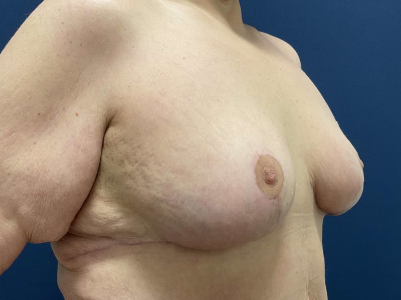  Breast Lift with Augmentation Dr. Booth Before & After Gallery - Patient 121632 - Image 4
