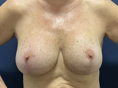 Breast Lift by Dr. Booth Before & After Gallery - Patient 343427 - Image 2