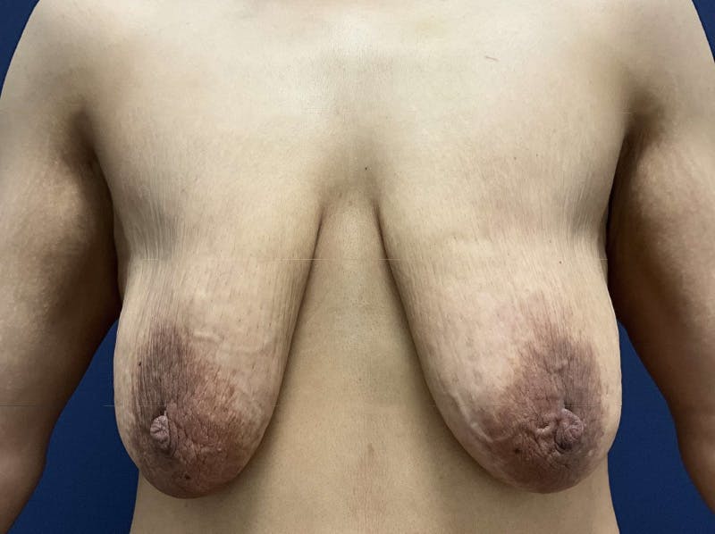Breast Lift by Dr. Booth Before & After Gallery - Patient 364750 - Image 1