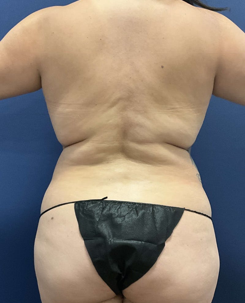 Liposuction by Dr. Booth Before & After Gallery - Patient 376021 - Image 2