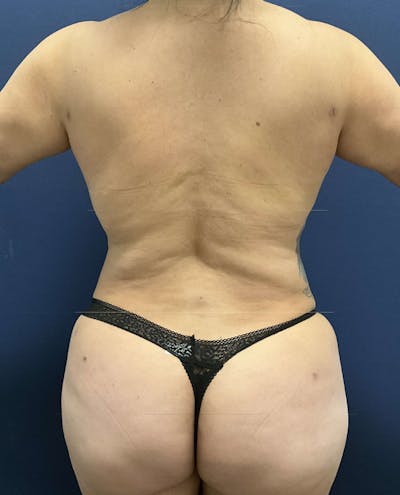 Liposuction by Dr. Booth Before & After Gallery - Patient 376021 - Image 1