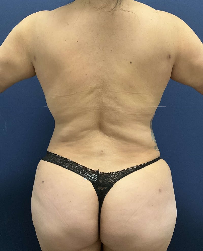 Liposuction by Dr. Booth Before & After Gallery - Patient 376021 - Image 1