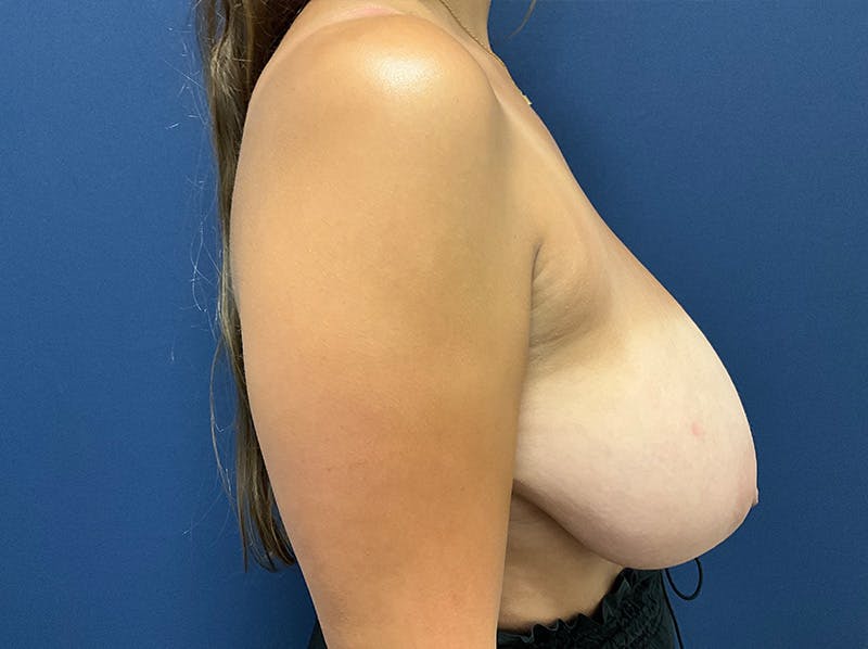 Breast Reduction by Dr. Booth Before & After Gallery - Patient 932764 - Image 5