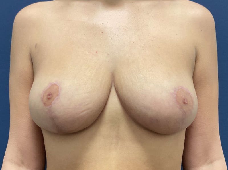 Breast Reduction by Dr. Booth Before & After Gallery - Patient 932764 - Image 2