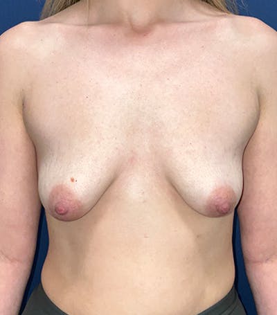  Breast Lift with Augmentation Dr. Booth Before & After Gallery - Patient 243133 - Image 1