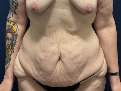 Tummy Tuck by Dr. Booth Before & After Gallery - Patient 233202 - Image 1