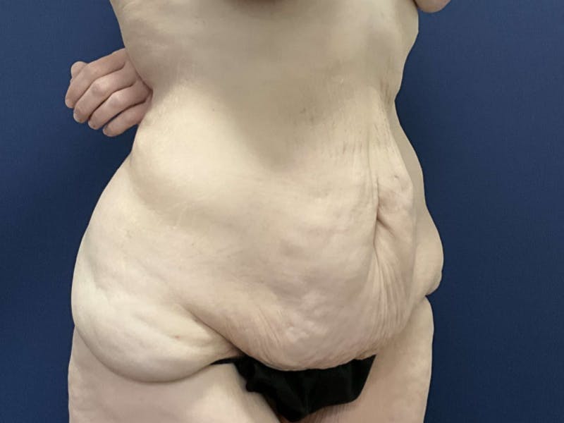 Tummy Tuck by Dr. Booth Before & After Gallery - Patient 233202 - Image 3