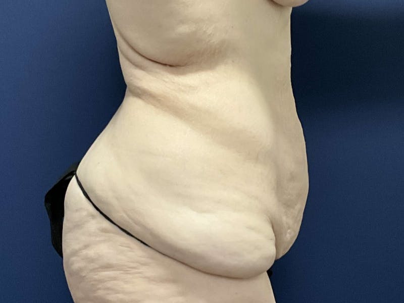 Tummy Tuck by Dr. Booth Before & After Gallery - Patient 233202 - Image 5